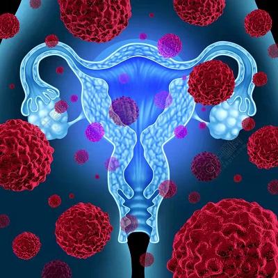 UpRi有望成为铂耐药卵巢癌更好的治疗选择