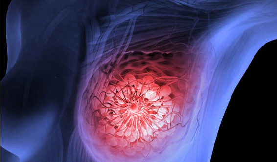 乳腺癌“杀手”阿那曲唑疗效如何？发病率骤降61%并维持12年！