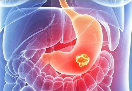 2023ASCO泰吉华（阿伐替尼）治疗胃肠道间质瘤mPFS 9.1个月