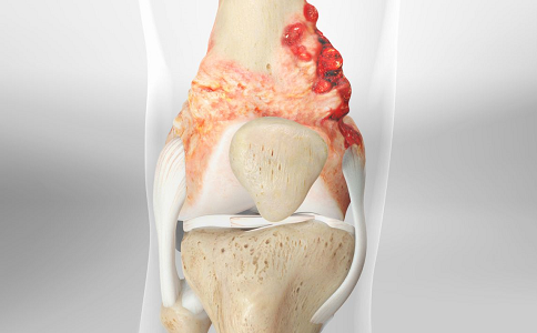 骨肉瘤和救星mepact的"自我介绍"